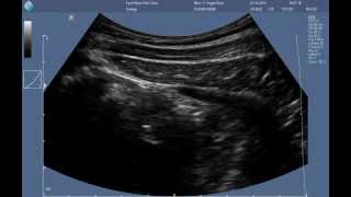 Abdominal RUSI ultrasound  correct contraction of the transversus abdominis [upl. by Dion]