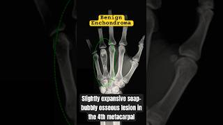 Tumor of the Hand shorts medical bones [upl. by Par]