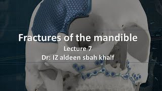 Fractures of the mandible lec 7 part 2  5th stage 2025 [upl. by Sileray]