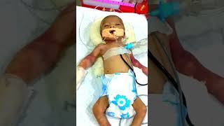 1 month baby on Ventilator machine RDS of Month  HMD p230 viralvideo nicucare ventilador [upl. by Millur]