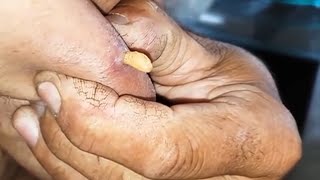 ❌️ COMO REMOVER BERNE DO BRAÇO DIREITO larva na mosca [upl. by Bennion557]