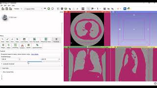 3D Slicer Demonstration CT ScanMRI to 3D Model  stl file [upl. by Eselahs]