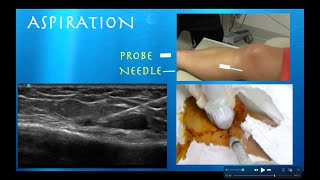 Ultrasound Guided Hoffas Fat Pad AspirationInjection by probeultrasoundcom [upl. by Yrogiarc]