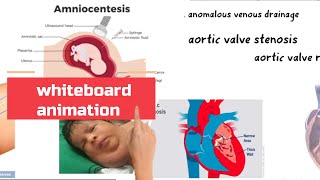 Turner Syndrome cause symptoms diagnosis treatment whiteboard animation [upl. by Aihsened752]