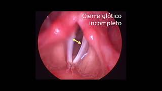 PARÁLISIS UNILATERAL DE CUERDA VOCAL TRATAMIENTO  UNILATERAL VOCAL FOLD PALSY TREATMENT [upl. by Svend811]