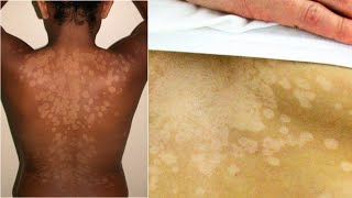 What is Tinea Versicolor Causes Treatment [upl. by Ailatan234]