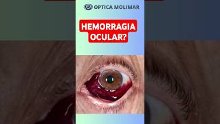 ¿QUÉ ES UNA HEMORRAGIA SUBCONJUNTIVAL O DERRAME OCULARcuidadovisualrevisiondelavistaojoslentes [upl. by Luapleahcim]