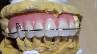 Pustiso with Retainer or Denture with Retainer by DatuAmbasTv [upl. by Notaes]