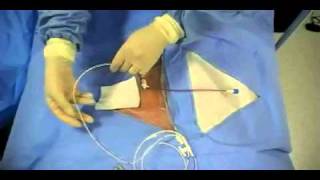 Insertion of Transvenous Pacemaker [upl. by Eitsym749]