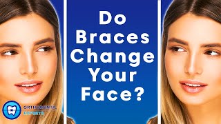 How Orthodontic Extractions can change Facial Profiles [upl. by Atsahs]