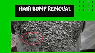 Hair Bump removals [upl. by Zacks]