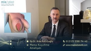 Meme Küçültme Ameliyatları  Op Dr Arda Katırcıoğlu [upl. by Artinek]