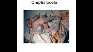 birth defect  omphalocele amp gastroschisis [upl. by Marcela]