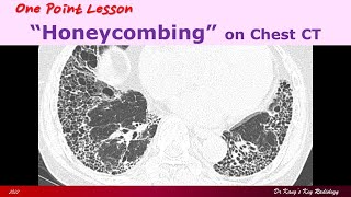 Honeycombing on Chest CT [upl. by Rory]