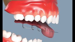 Calage dentaire  réalignement occlusal l’orthodontie chez l’enfant [upl. by Olmsted]