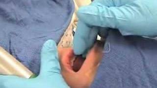 IntubationHow to perform endotracheal intubation  2 [upl. by Lapo]