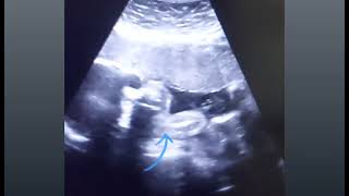 Anterior placenta with 28 weeks baby movements gender amp 3VCord  8 weeks pregnancy with heartbeat [upl. by Aicsile]