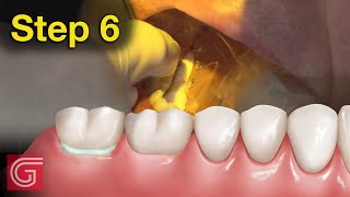 HOW TO Cement Zirconia Crown for Less Retentive Tooth Prep [upl. by Jammie35]