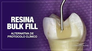 Resina Bulk Fill Alternativa de protocolo clínico [upl. by Notlrac363]