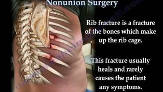 Rib Fracture Nonunion Surgery  Everything You Need To Know  Dr Nabil Ebraheim [upl. by Ybbob]