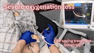 How to treat a lifethreatening anesthesia emergency in pediatric surgery [upl. by Caralie]