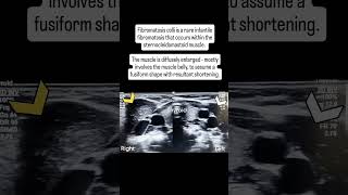 Fibromatosis colli radiology [upl. by Ardnaet]