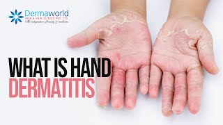 What is Hand dermatitis Shots [upl. by Furlong]