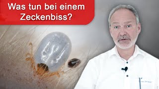 Zeckenbiss  was tun Impfung gegen Borreliose und FSME [upl. by Chee]