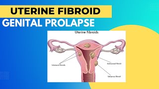 Uterine fibroid l Genital prolapse l causes l symptoms l treatment l Gynaecology bamslectures [upl. by Leeanne]