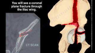 Acetabular Fracture Associated BOTH Columns  Everything You Need To Know  Dr Nabil Ebraheim [upl. by Niliak]