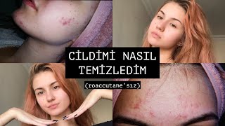 SİVİLCELERİMDEN NASIL KURTULDUM ✨ roaccutane’sız [upl. by Akoyin]