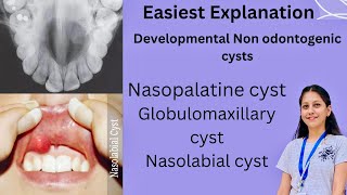 Developmental Non Odontogenic cysts Oral Pathology BDS Nasopalatine Globulomaxillary Nasolabial [upl. by Lebasiram428]