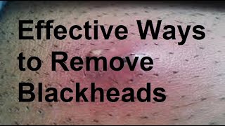 Effective Ways to Remove Blackheads [upl. by Antebi]