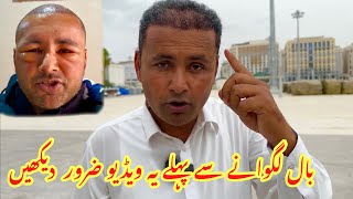 Must Watch Before Hair Transplant  Hair Transplant Complete Process and Final Results  Mubashir [upl. by Ahsiram]