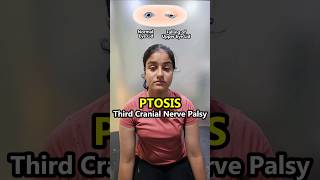 😭🥺 PTOSIS  Oculomotor nerve 3rd cranial nerve palsies Dropping of the eyelid  physiotherapy [upl. by Rollecnahc404]