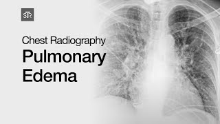 Chest Radiography Pulmonary Edema [upl. by Mays718]