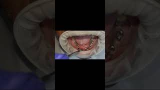 Lower arch full basal dental implants 8 welded post 5 months healing check shorts [upl. by Anhaj]