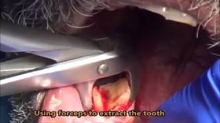 Severely attrited lower first molar extraction [upl. by Rey]