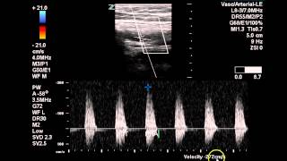 Bilateral Lower Extremity Arterial Duplex  Case Study [upl. by Yasmar]