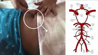 AORTIC COMPRESSION Postpartum Hemorrhage [upl. by Nyllek494]