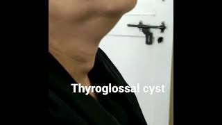 Thyroglossal cyst [upl. by Nosaes962]