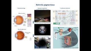 Retinitis pigmentosa pathophysiology and treatment advances [upl. by Far114]