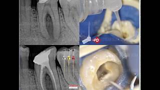 Endoactivator  PD Special Plastic Injector Irrigation Single Visit Root Canal Treatment [upl. by Sirrom]