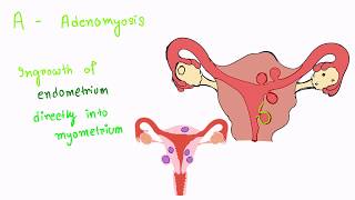 Causes of Menorrhagia [upl. by Conan901]