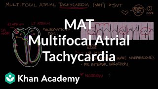 Multifocal atrial tachycardia MAT  Circulatory System and Disease  NCLEXRN  Khan Academy [upl. by Hollie316]