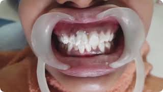 GC Tooth Mousse Application [upl. by Airdnat]