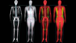 ¿Qué es la Desintometría Ósea [upl. by Akcirret102]