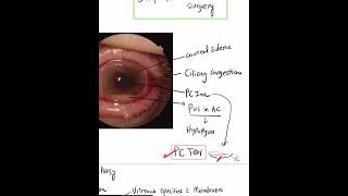 Acute Postoperative Endophthalmitis  Case Discussion In A Minute Mustknow Shorts [upl. by Land281]