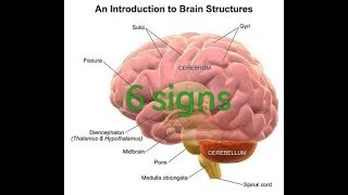 6 signs or symptoms of cerebral edema [upl. by Abate]