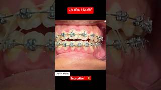 Dental Braces Orthodontics dentist fypforyou trending viral [upl. by Enneyehc]